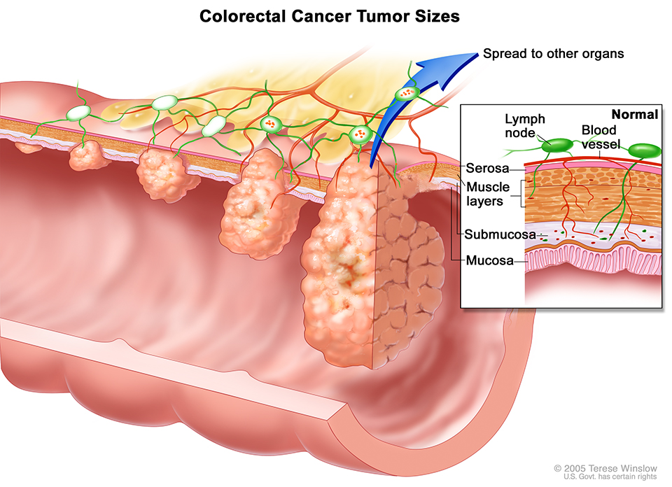 Colorectal Cancer Tumor Sizes Copyright © 2005 Terese Winslow